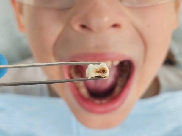 Best Emergency Root Canal Treatment in Crooks, SD